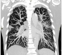 肺野腫瘍（MIP）